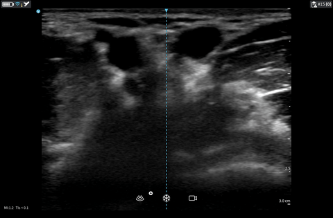 Compressible vein on ultrasound