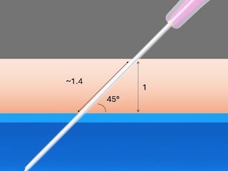 Picture showing eedle length and angle