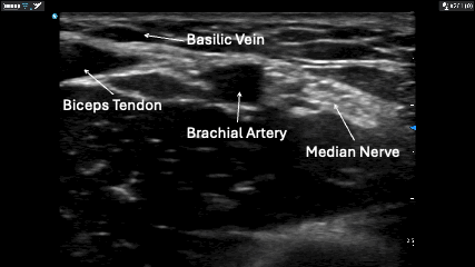 Ultrasound image showing median nerve alongside brachial artery
