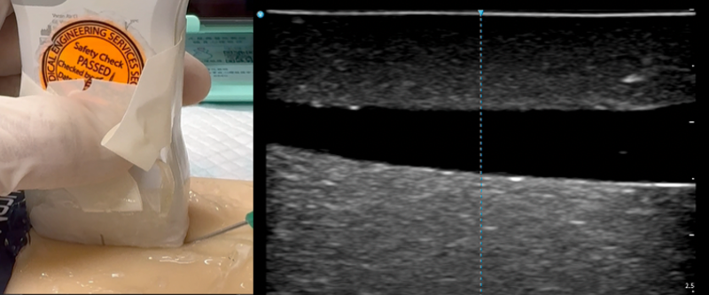 Insert the needle and advance slowly