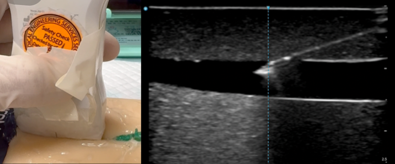 Tent and pop the vessel wall