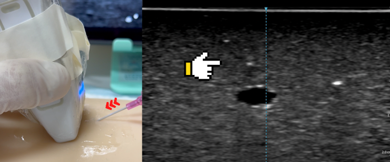 Insert the needle and locate the tip