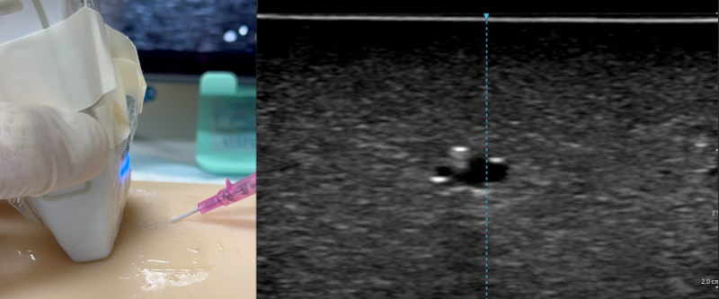 Tent the vessel wall and pop it