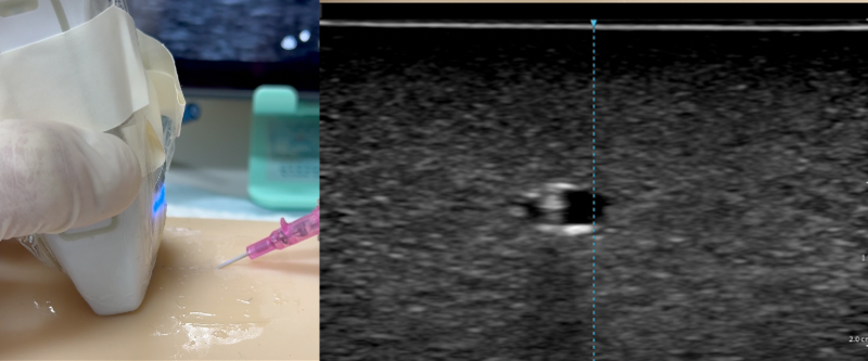 The needle tip within vessel showing as the “bull’s eye”