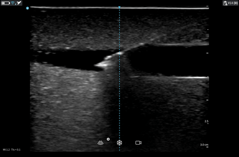 Withdrawing the needle shown on long axis view
